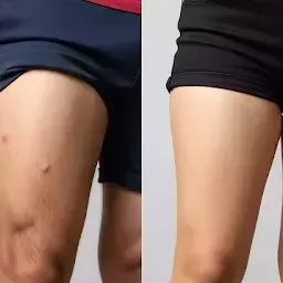 Melasma & Uneven Skin Tone