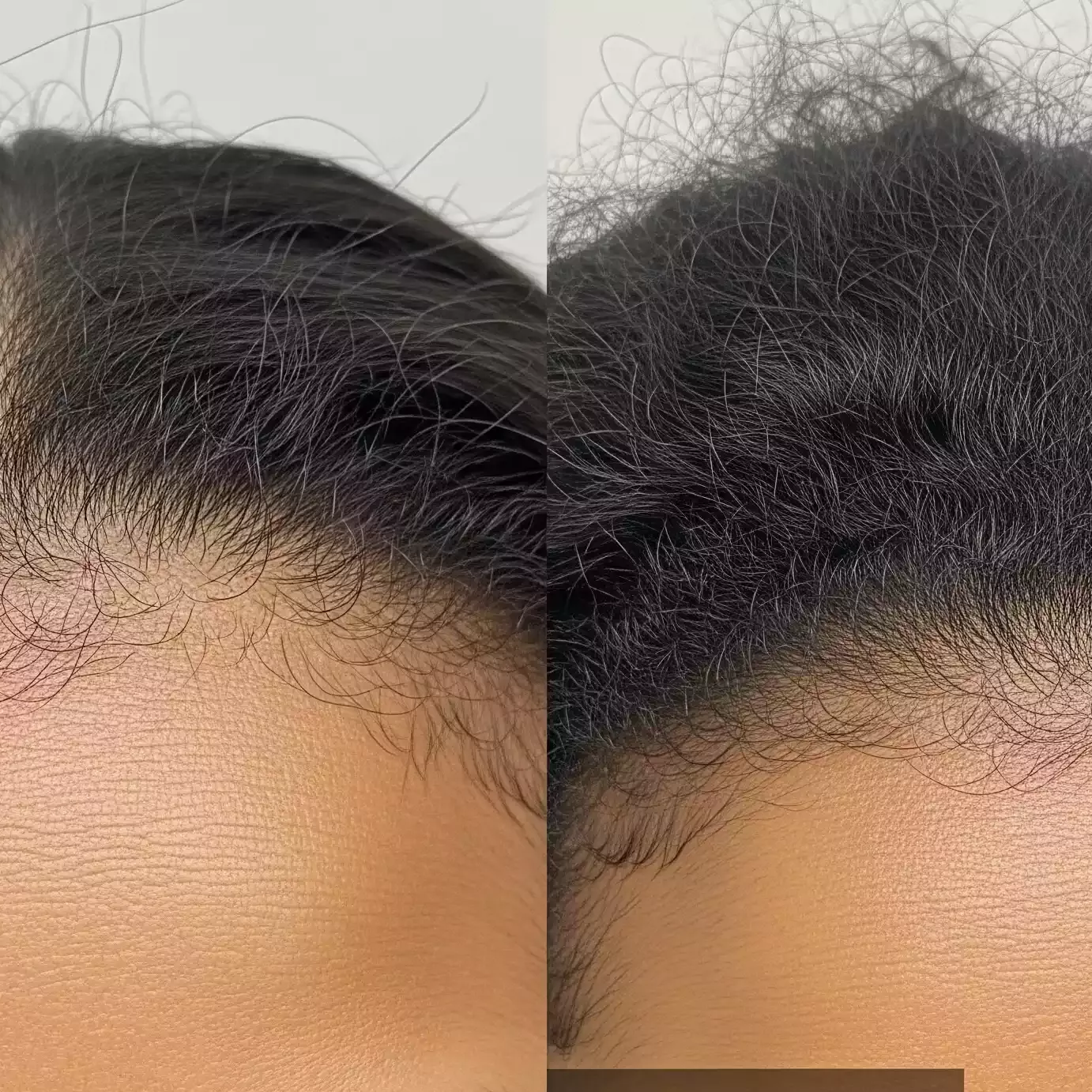 Sagging & Loose Skin